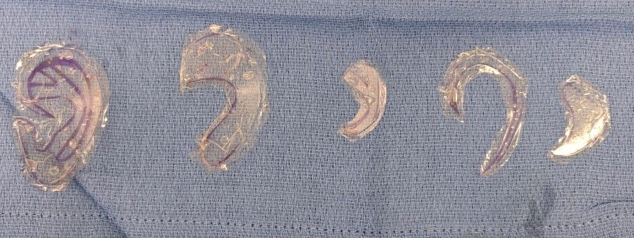 Calque d'oreille dans le cas d'une reconstruction avec maquette auriculaire